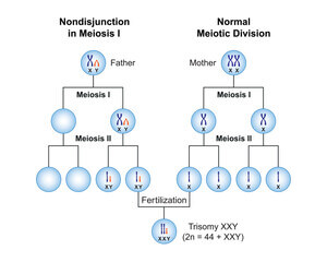 클라인펠터 증후군&amp;#44; 남자가 유방이 나온다면? 대표적인 증상입니다. 클라인펠터 증상은 다양하게 더 있습니다. 어떤 증상과 원인 그리고 진단과 치료에 대해 알아봤습니다. 참고하시기 바랍니다. 