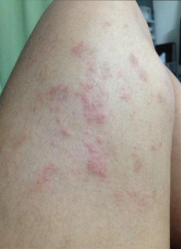 항문 습진 질환 가려움 관리 요령