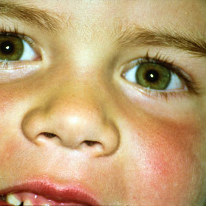 감염성 홍반 증상 - 가벼운 가려움