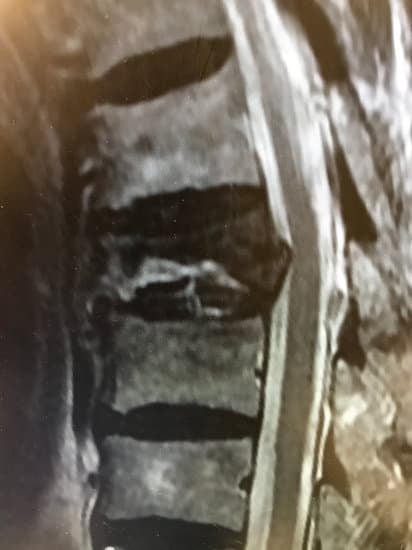 척추 압박 골절 – 별다른 충격 없이도 허리가 골절될 수 있다?