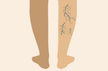 하지정맥류 증상, 수술비용, 도움이 되는 운동