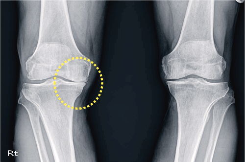 콘드로이친 효능 부작용