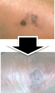 흑색종 발바닥