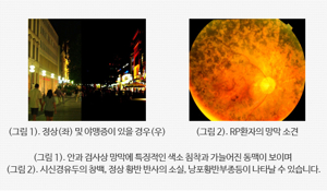 망막변성