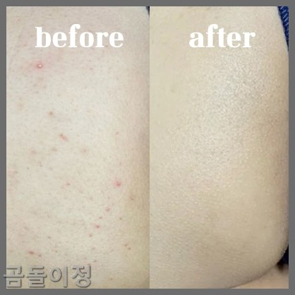 성인 엉덩이 두드러기 땀띠 뾰루지, 병원 안 가고 해결한 방법