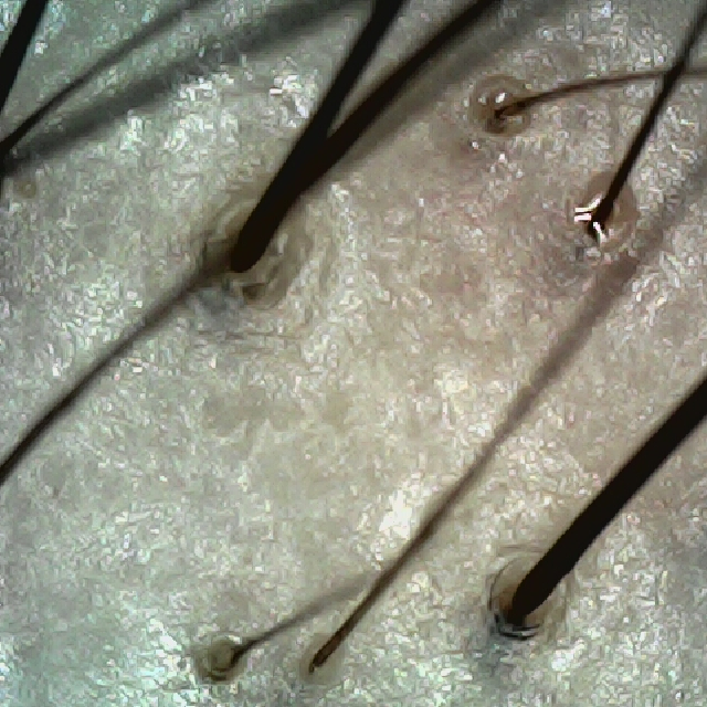 탈모 극복 프로젝트 - 정수리와 이마 사이 두피 모습이다.