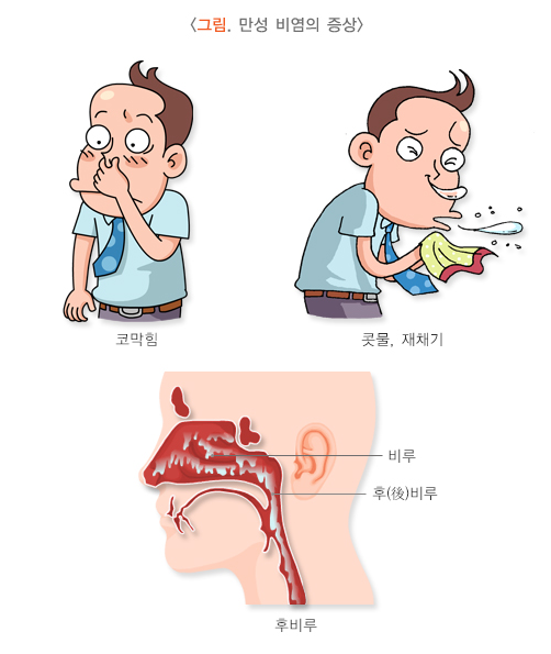 환절기 비염 예방법