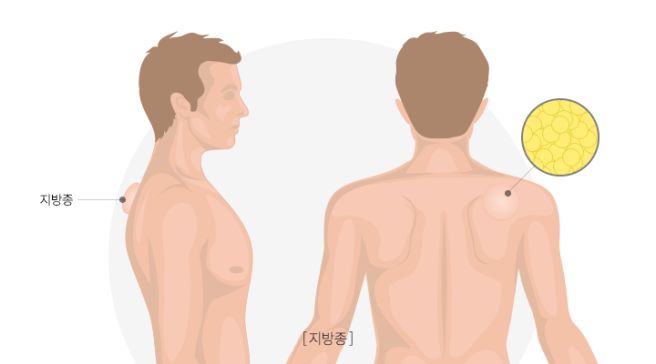 지방종 원인