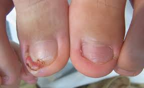 내성발톱 자가치료