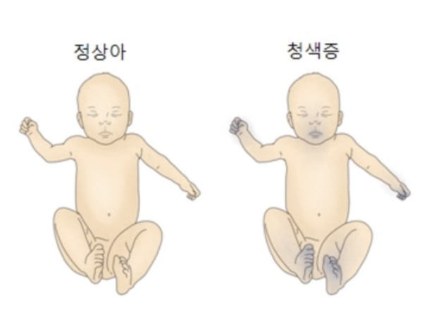 곤봉지와 청색증, 우리 몸이 보내는 심장 위험 경고