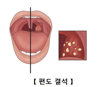 편도결석 원인
