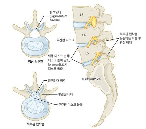 척추 협착증 원인