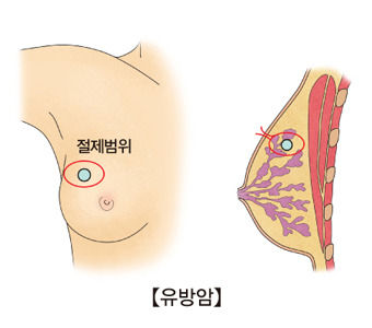 유방암 초기증상
