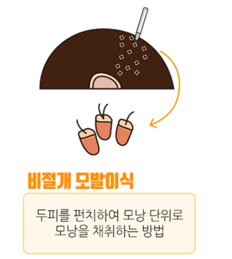 비절개방식