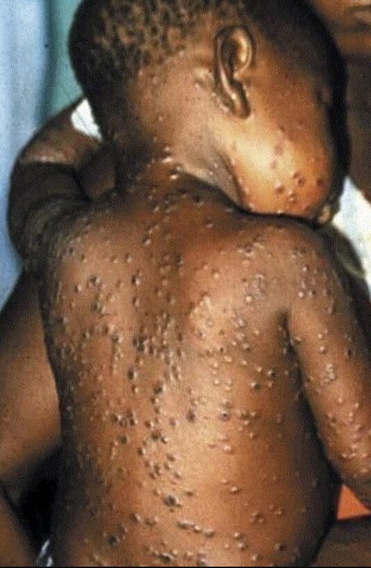 원숭이 두창 관련주 원숭이 두창이란?