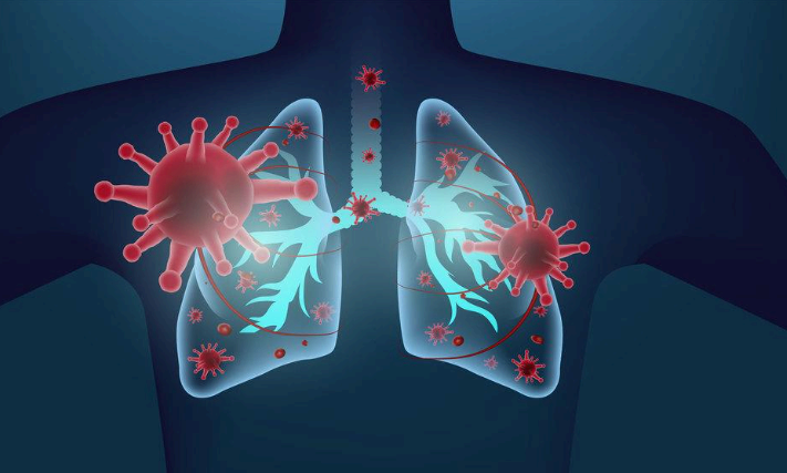 마이코플라즈마 폐렴