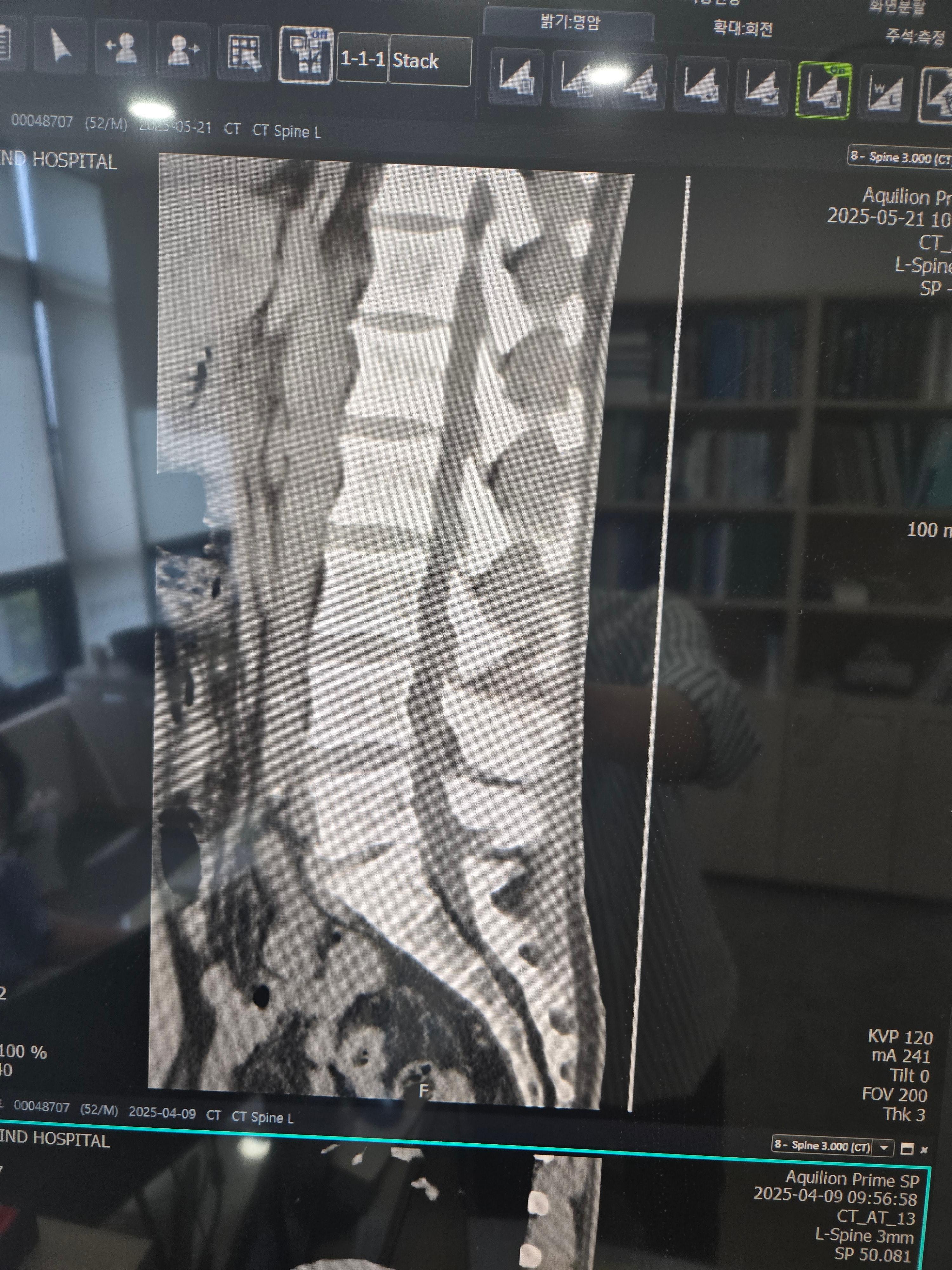 필자의 허리디스크 수술 후 MRI 결과