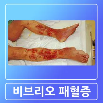 패혈증이란 무엇인지 원인 증상 치료 예방법_5