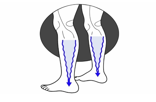하지정맥류 원인과 의심증상