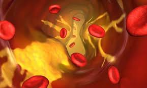 콜레스테롤 낮추는 방법 10가지