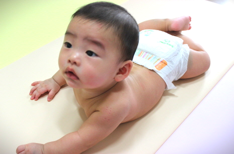 땀띠 가라앉히는 방법 습진 증상 없애는 법