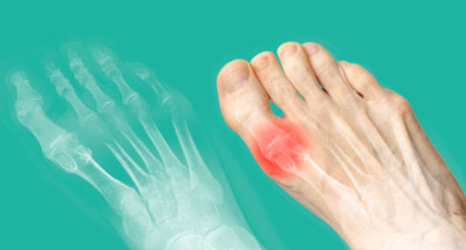 발가락 관절염 