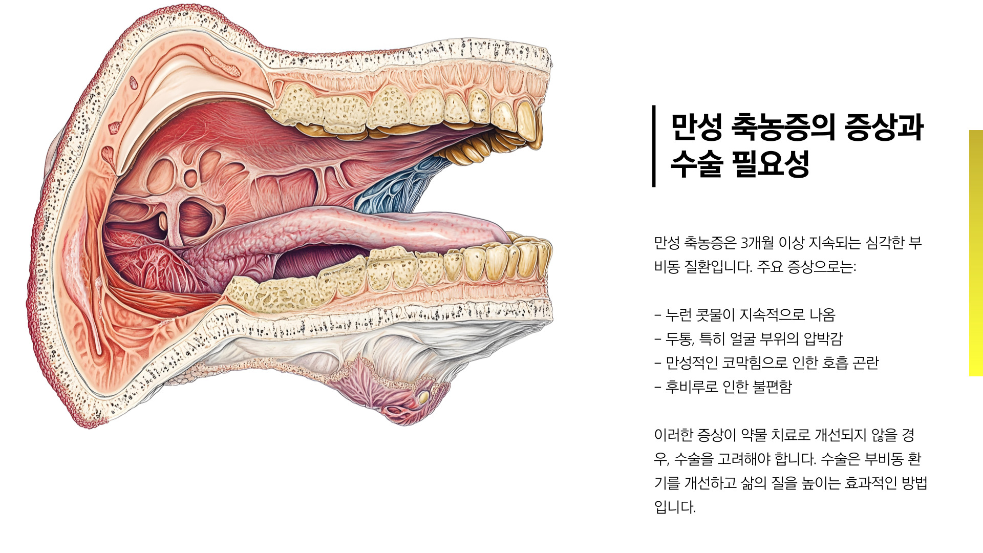 축농증 수술 비용