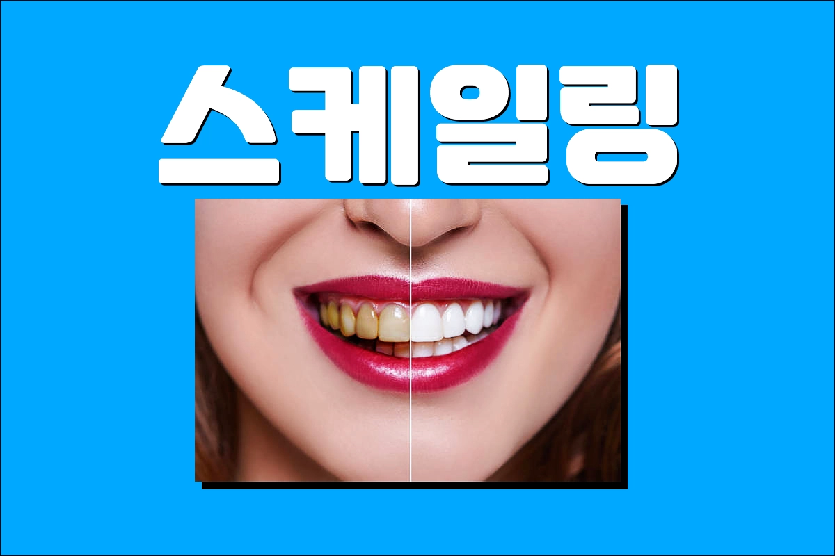 스케일링 비용 스케일링 후 식사 스케일링 주기 스케일링 술 담배 커피 음식 통증 피 잇몸 시림 부음