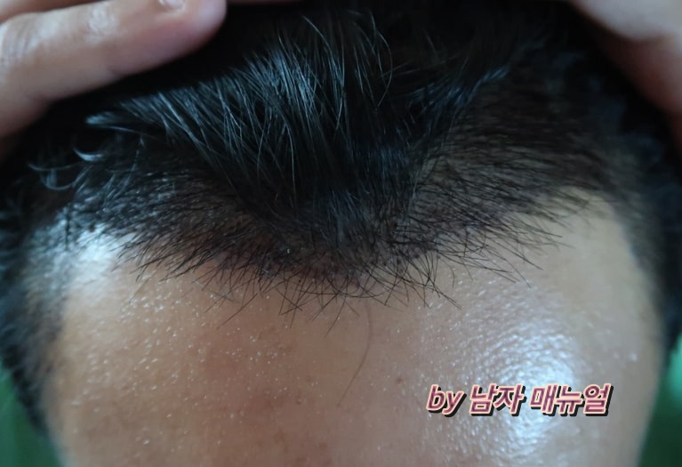 비절개-모발이식-사진