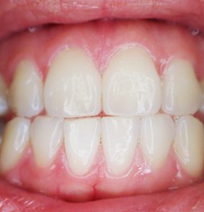 이빨이-우수수-빠지는-꿈-사진