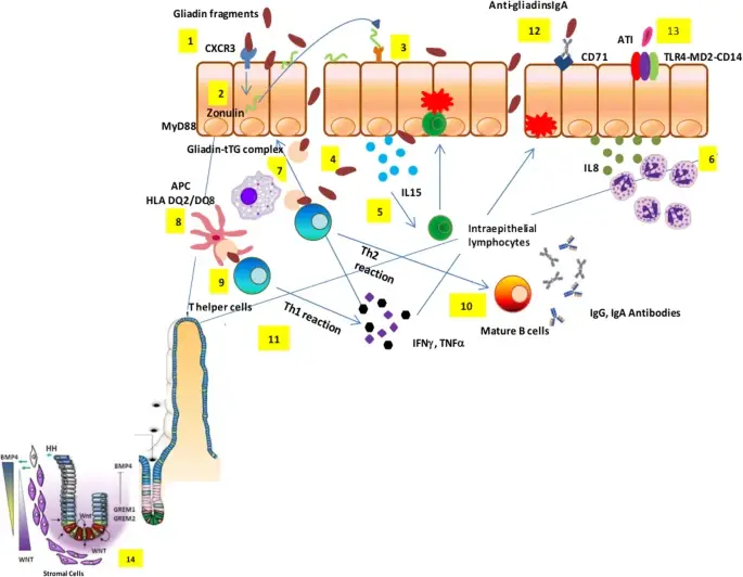 실리악병 발병 기전; 최신 연구 동향과 관리 방법