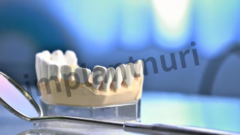 덴티스 임플란트