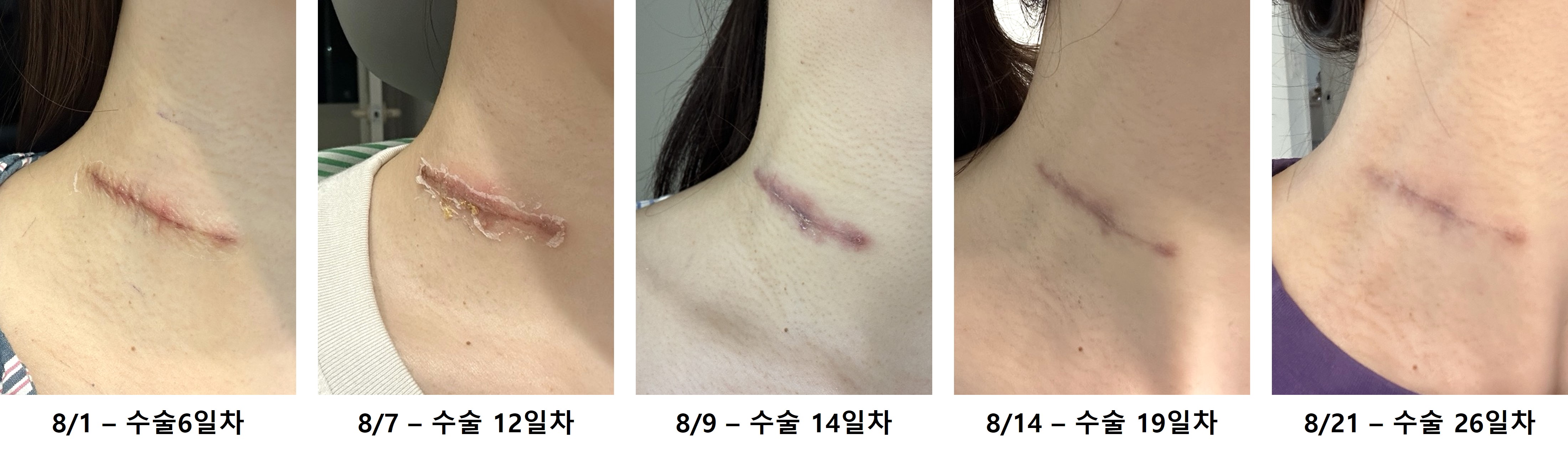 갑상선 암, 림프절 암 수술 후기, 수술 흉터 관리