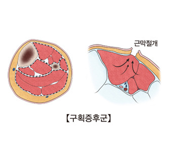 급성 구획증후군 증상.원인.치료
