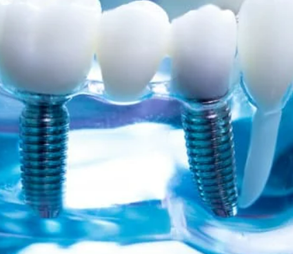 임플란트 가격 비교 사이트별 비용 총정리