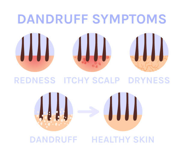 지루성 두피염 치료에서 레이저 치료의 효과와 기전