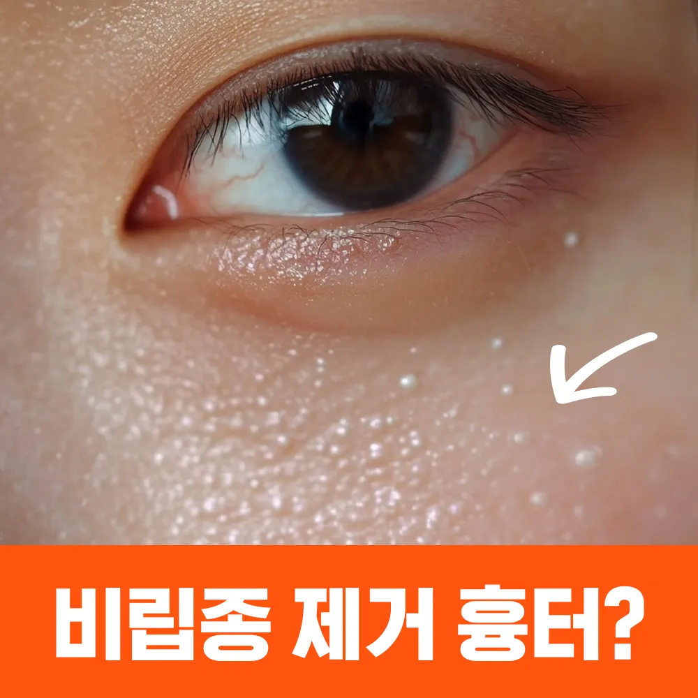 비립종 생기는 이유 비립종 없애는 방법 피부 관리법_2