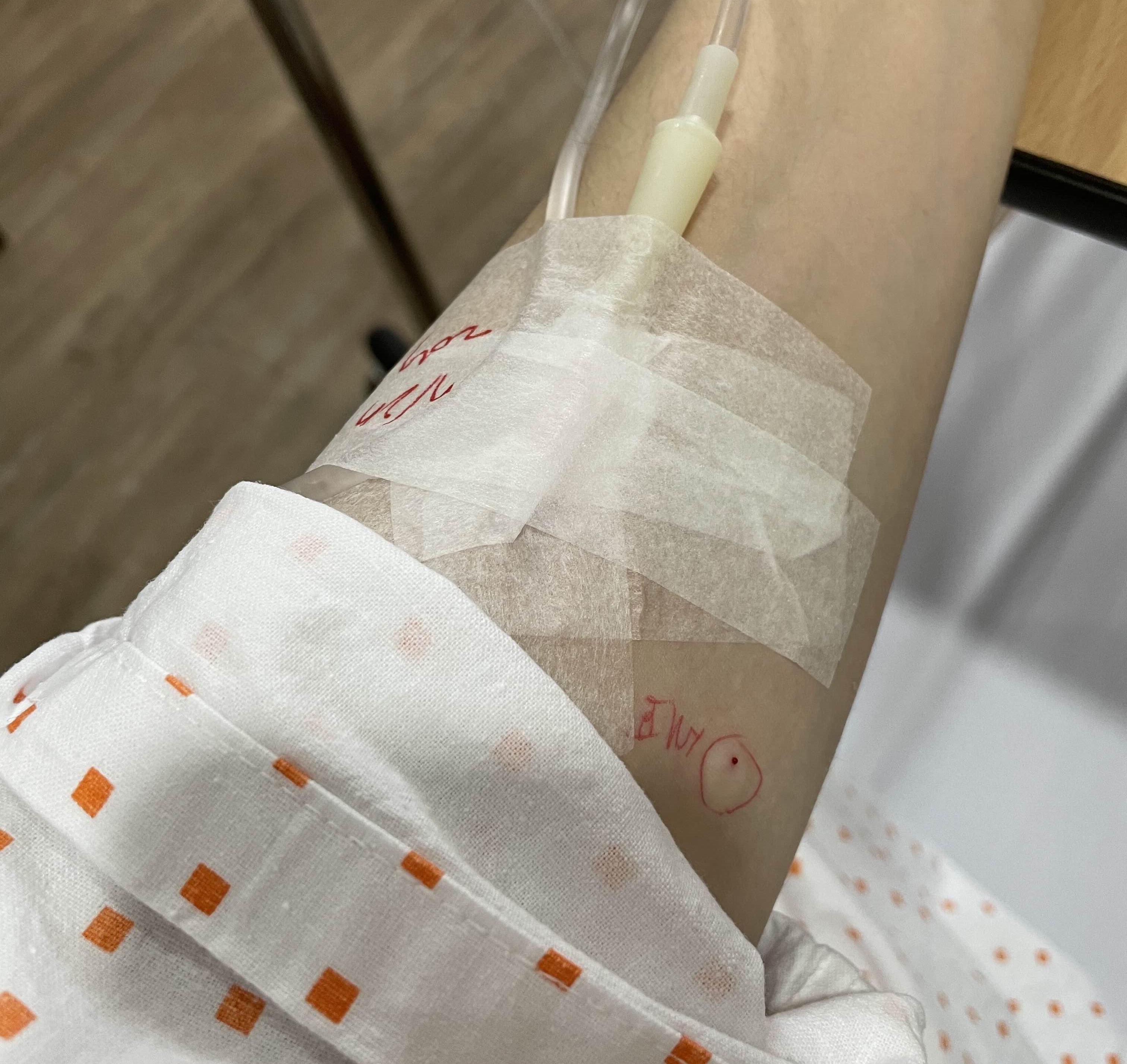 편도절제 수술 전 항생제 테스트