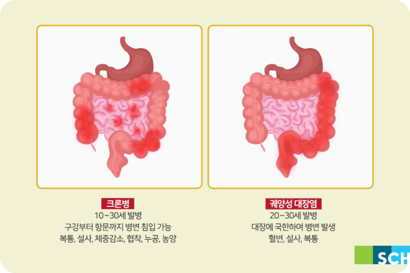 크론병과 궤양성 대장염의 차이