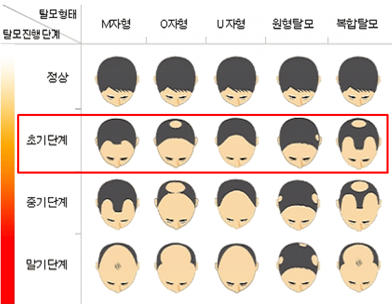 탈모 초기증상 체크리스트 (자가진단 방법)