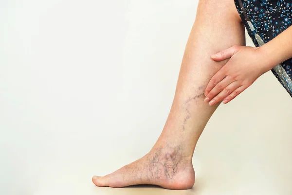 하지 정맥류 증상