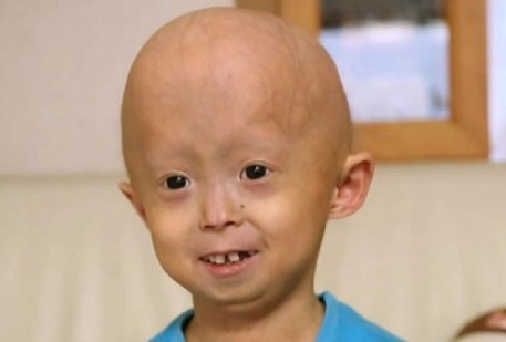 소아조로증 수명