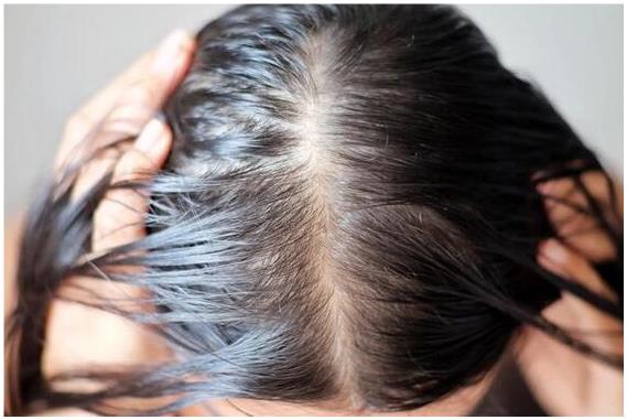 정수리 여성 탈모