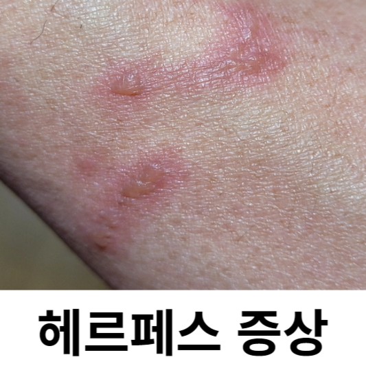 헤르페스 증상