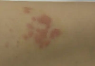 대상포진-예방접종-무료-가격-종류-건강