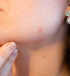 여드름 빨리 없애는 방법