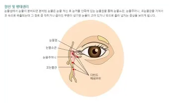 눈물샘 뚫는 수술 간단한가요에 대한 수술정보_2