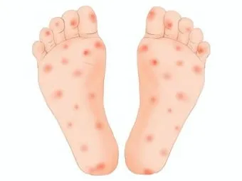 수족구 초기 증상 어른 감염 격리기간 예방 치료 완전 가이드_4