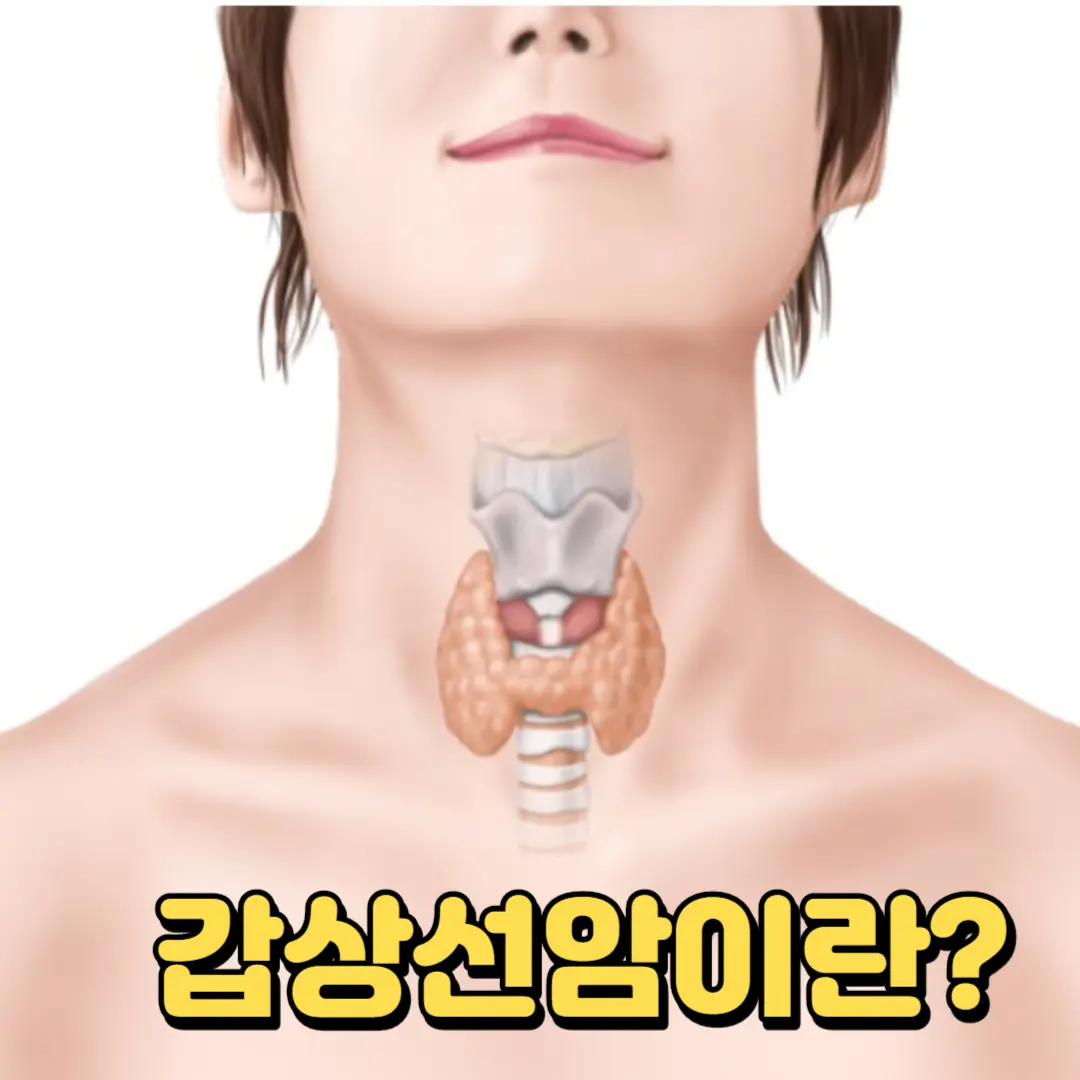 갑상선암이란