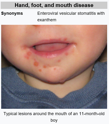 수족구병 증상 및 예방 조치